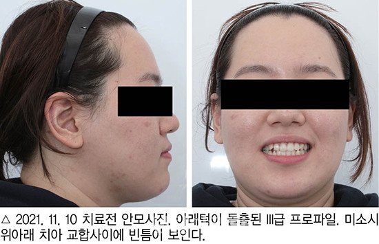 개방교합 비발치 교정 임상 1