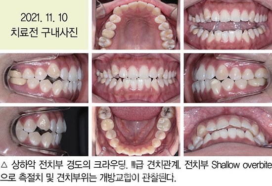 개방교합 비발치 교정 임상 2