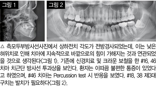 개방교합 비발치 교정 임상 3
