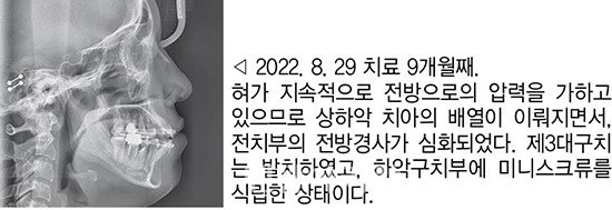 개방교합 비발치 교정 임상 5