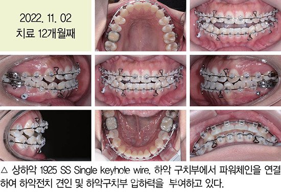 개방교합 비발치 교정 임상 6