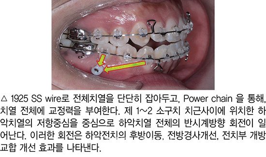 개방교합 비발치 교정 임상 7