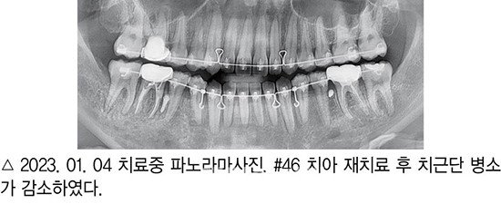 개방교합 비발치 교정 임상 8