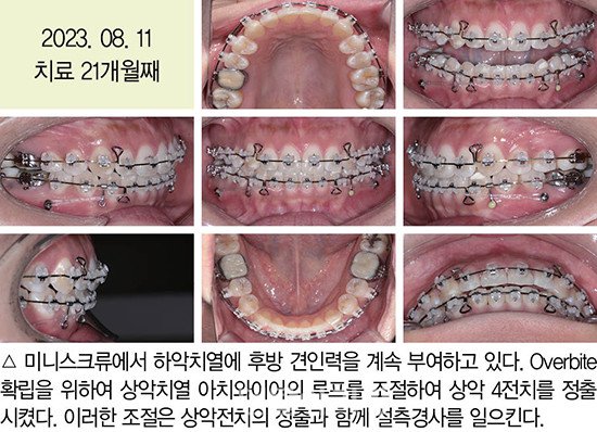 개방교합 비발치 교정 임상 9