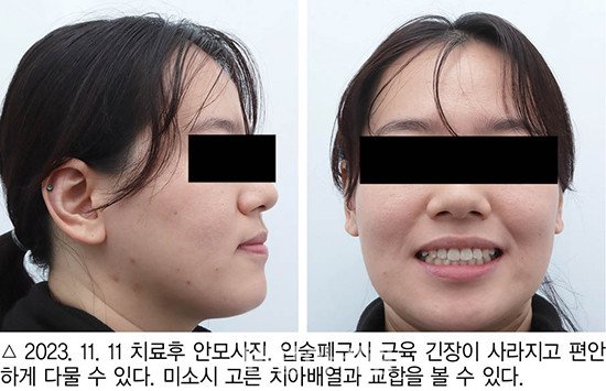 개방교합 비발치 교정 임상 10