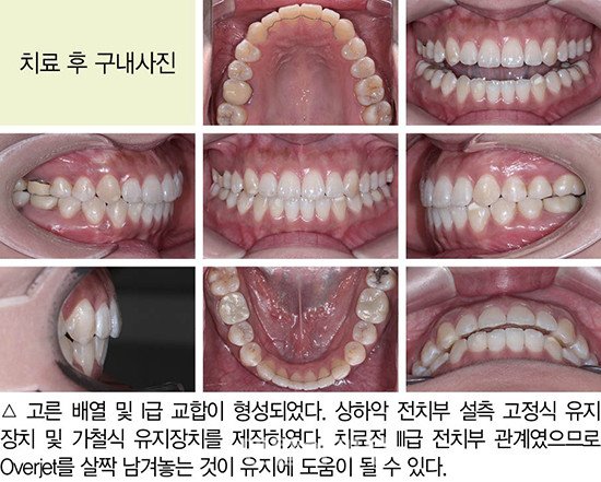 개방교합 비발치 교정 임상 11