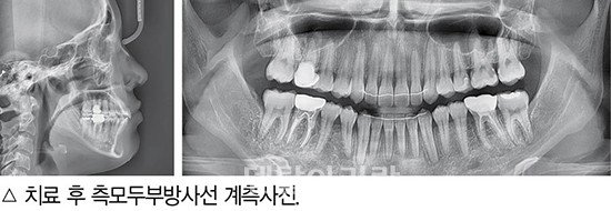 개방교합 비발치 교정 임상 12