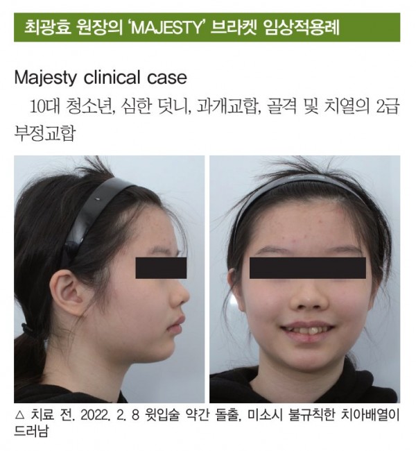 덧니 과개교합 교정 임상 1