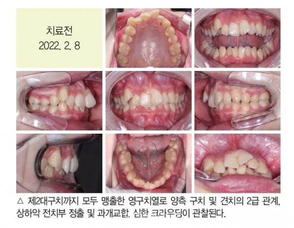 덧니 과개교합 교정 임상 2