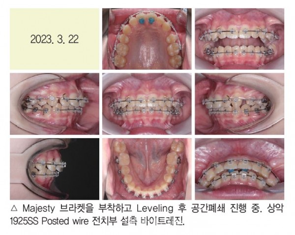 덧니 과개교합 교정 임상 4