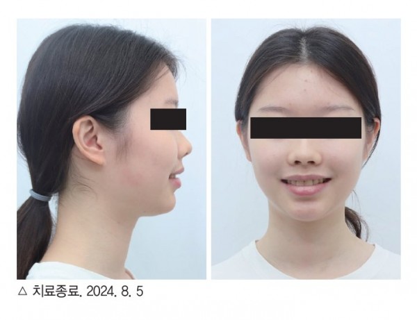 덧니 과개교합 교정 임상 6
