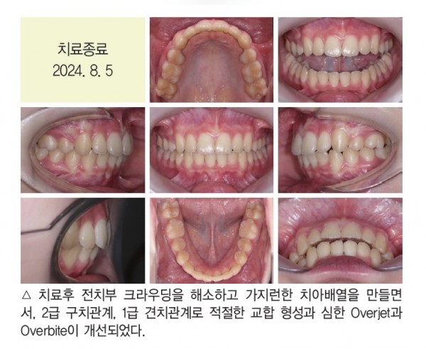덧니 과개교합 교정 임상 7