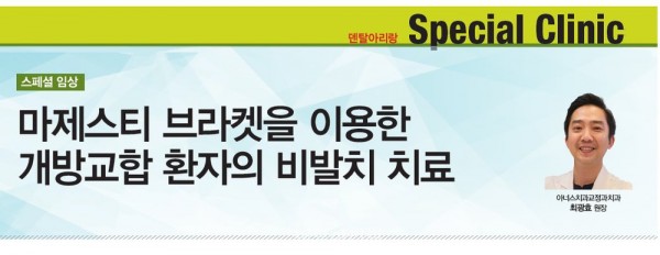 개방교합 비발치 교정 증례